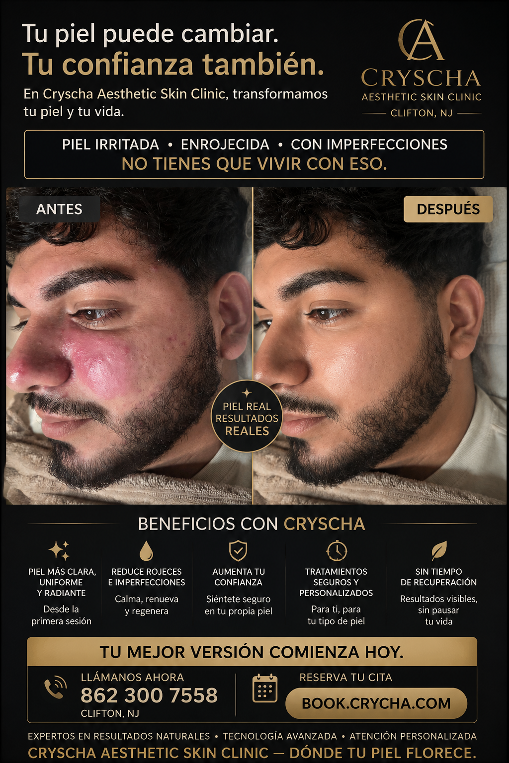 facial seboorrea en clifton