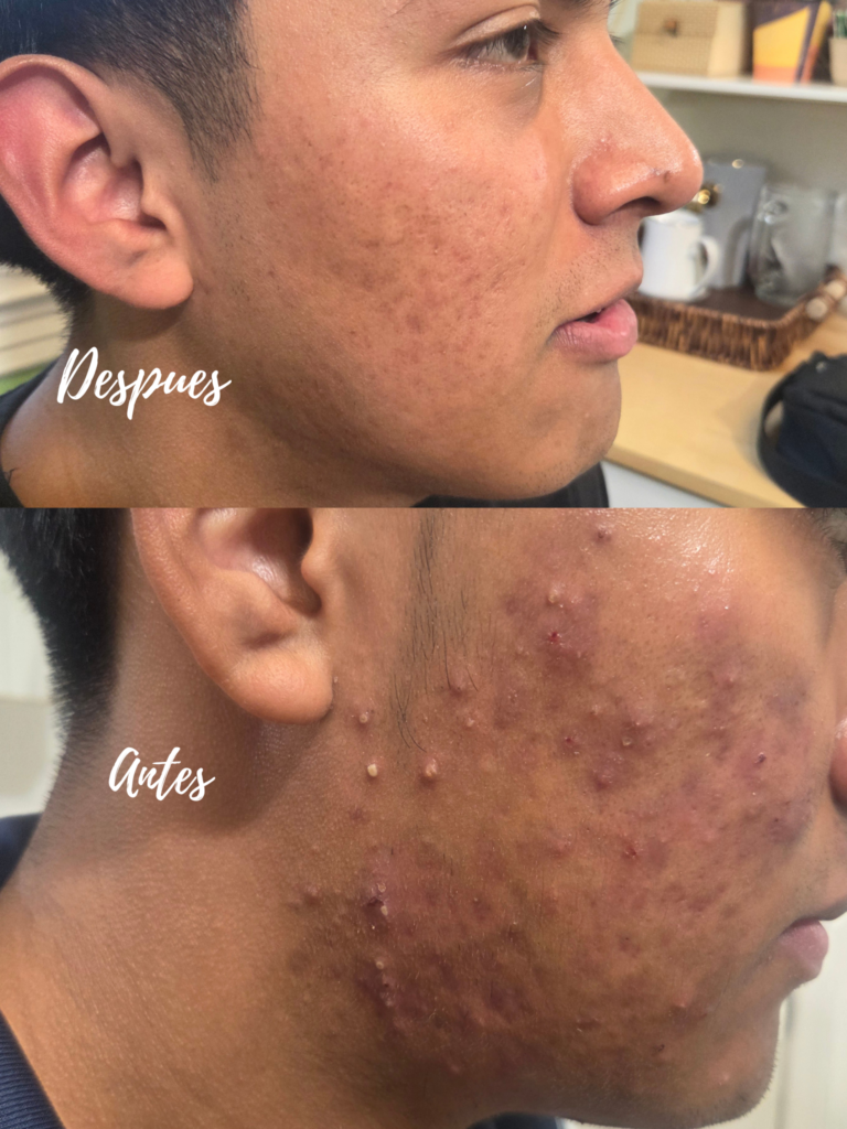 acne antes y despues clifton,nj